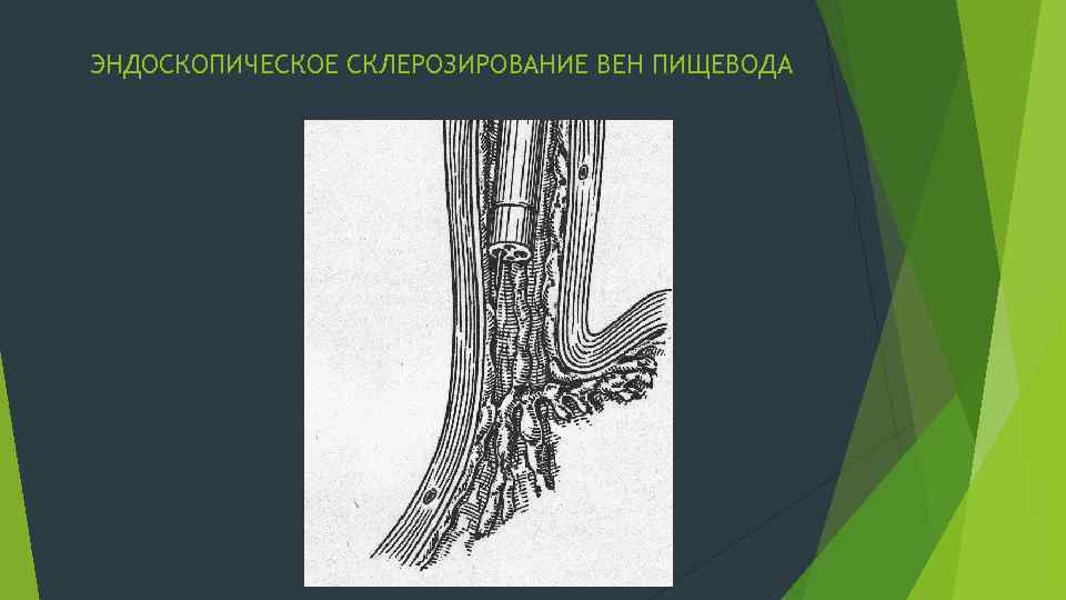 ЭНДОСКОПИЧЕСКОЕ СКЛЕРОЗИРОВАНИЕ ВЕН ПИЩЕВОДА 