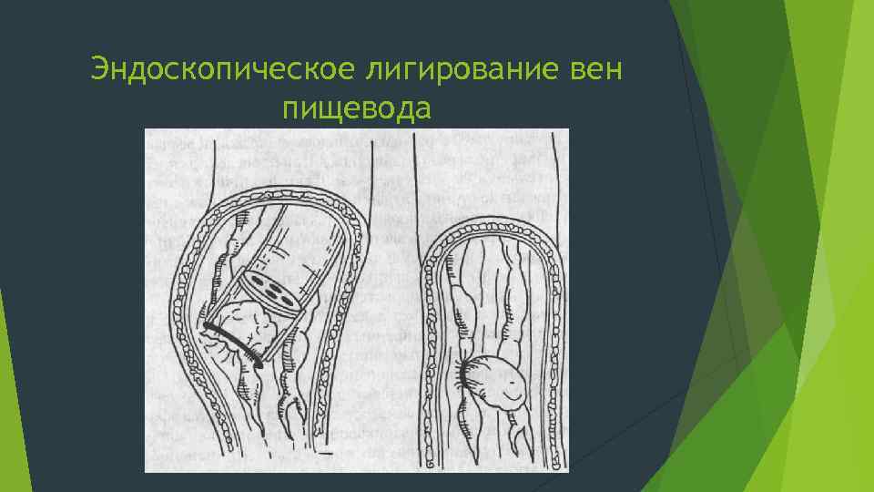 Эндоскопическое лигирование вен пищевода 