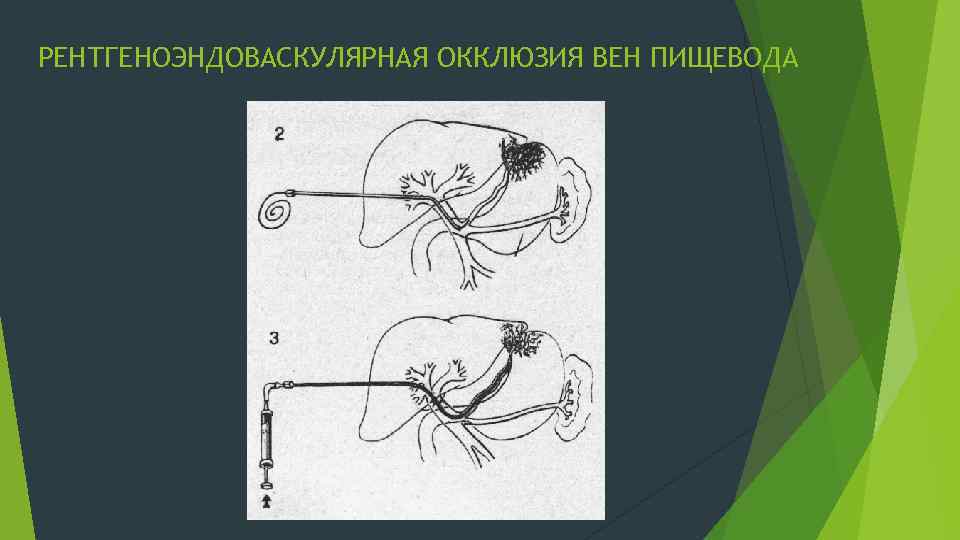 РЕНТГЕНОЭНДОВАСКУЛЯРНАЯ ОККЛЮЗИЯ ВЕН ПИЩЕВОДА 