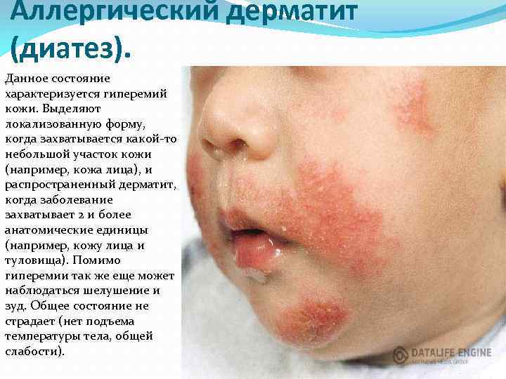 Аллергический дерматит (диатез). Данное состояние характеризуется гиперемий кожи. Выделяют локализованную форму, когда захватывается какой-то