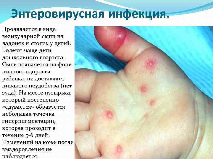 Энтеровирусная инфекция. Проявляется в виде везикулярной сыпи на ладонях и стопах у детей. Болеют