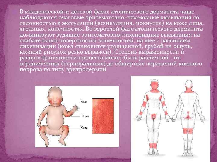  В младенческой и детской фазах атопического дерматита чаще наблюдаются очаговые эритематозно-сквамозные высыпания со