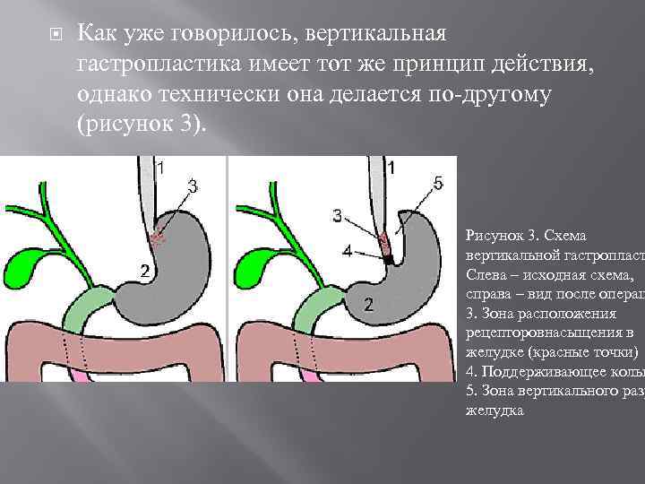  Как уже говорилось, вертикальная гастропластика имеет тот же принцип действия, однако технически она