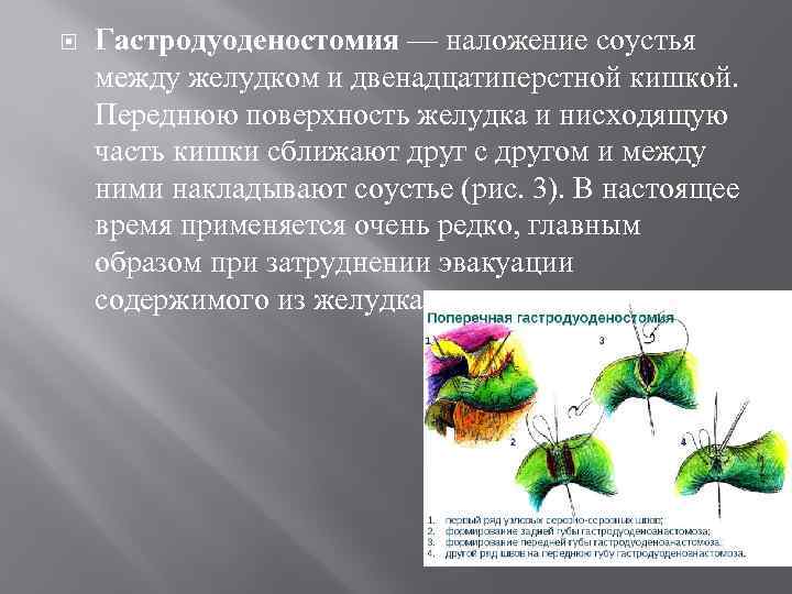  Гастродуоденостомия — наложение соустья между желудком и двенадцатиперстной кишкой. Переднюю поверхность желудка и