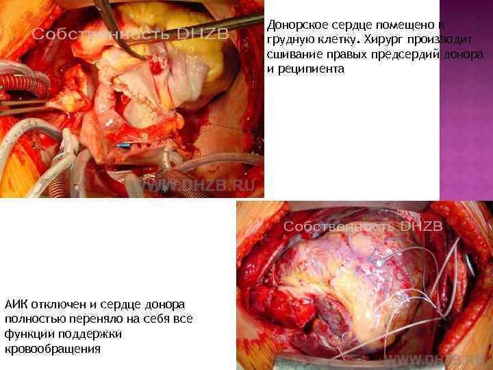 Донорское сердце помещено в грудную клетку. Хирург производит сшивание правых предсердий донора и реципиента