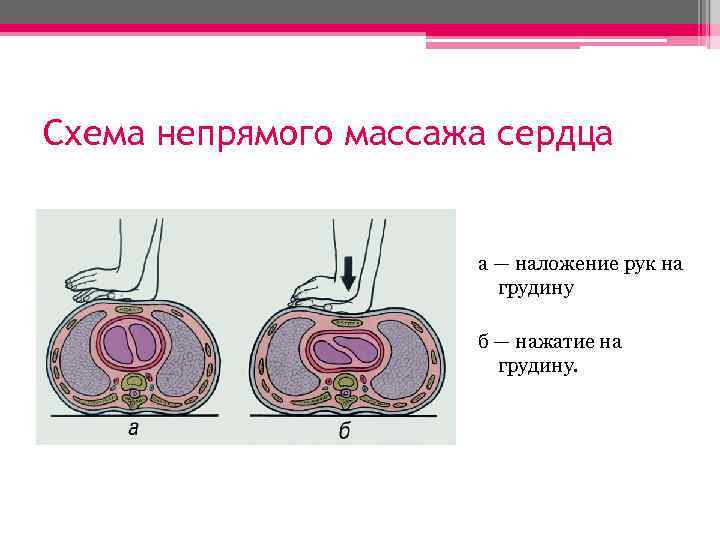 Схема непрямого массажа сердца а — наложение рук на грудину б — нажатие на