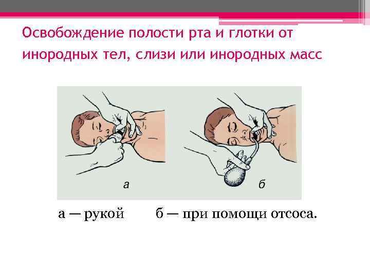 Освобождение полости рта и глотки от инородных тел, слизи или инородных масс а —