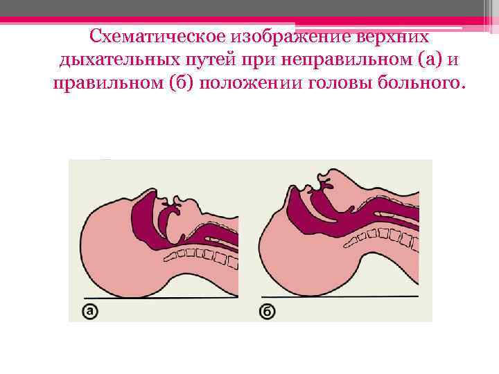 Схематическое изображение верхних дыхательных путей при неправильном (а) и правильном (б) положении головы больного.