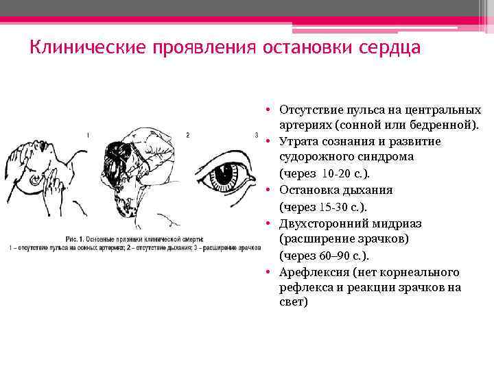 Клинические проявления остановки сердца • Отсутствие пульса на центральных артериях (сонной или бедренной). •