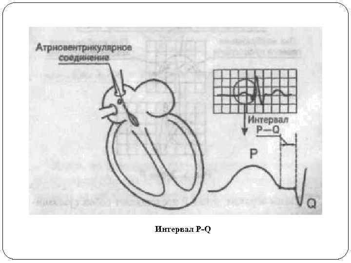 Интервал Р-Q 