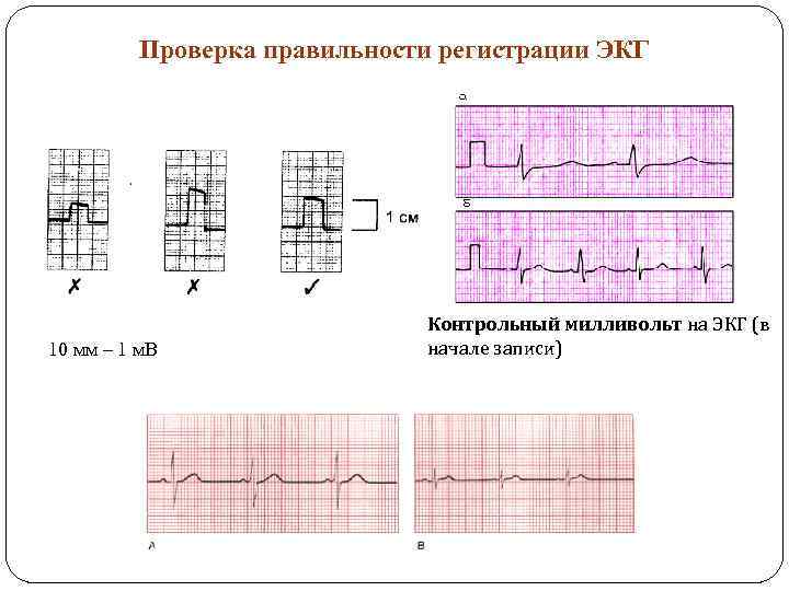 Точки экг. Контрольный Вольтаж на ЭКГ. Контрольный милливольт на ЭКГ. МВ В мм на ЭКГ. Вольтаж ЭКГ 20 мм МВ.