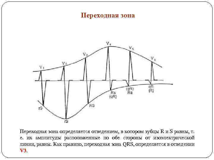 Переходная зона определяется отведением, в котором зубцы R и S равны, т. е. их