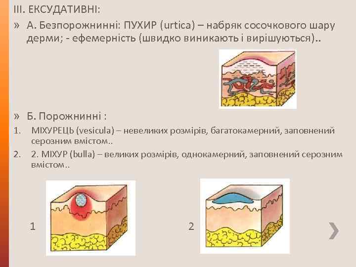 ІІІ. ЕКСУДАТИВНІ: » А. Безпорожнинні: ПУХИР (urtiса) – набряк сосочкового шару дерми; - ефемерність