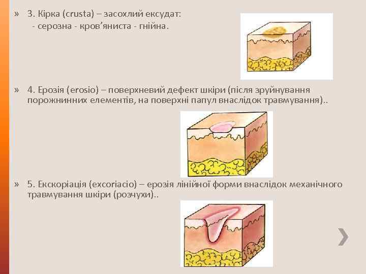 » 3. Кірка (crusta) – засохлий ексудат: - серозна - кров’яниста - гнійна. »