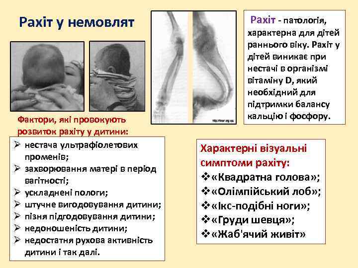 Рахіт у немовлят Фактори, які провокують розвиток рахіту у дитини: Ø нестача ультрафіолетових променів;