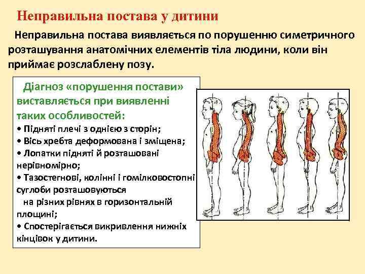 Неправильна постава у дитини Неправильна постава виявляється по порушенню симетричного розташування анатомічних елементів тіла