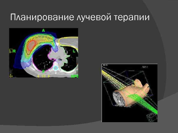 План лучевой терапии