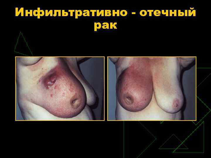 Инфильтративно - отечный рак 