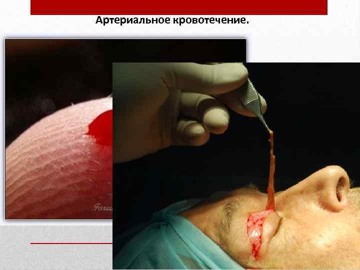Артериальное кровотечение. 