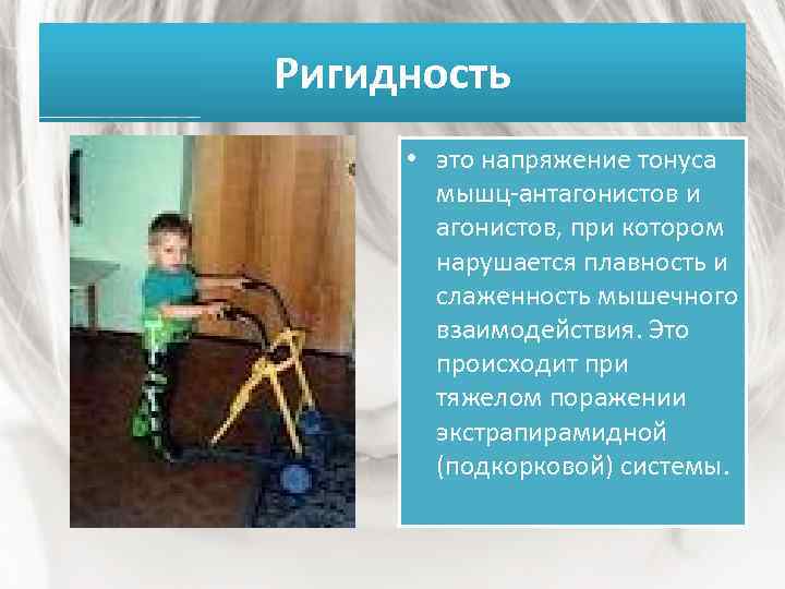 Ригидность • это напряжение тонуса мышц-антагонистов и агонистов, при котором нарушается плавность и слаженность