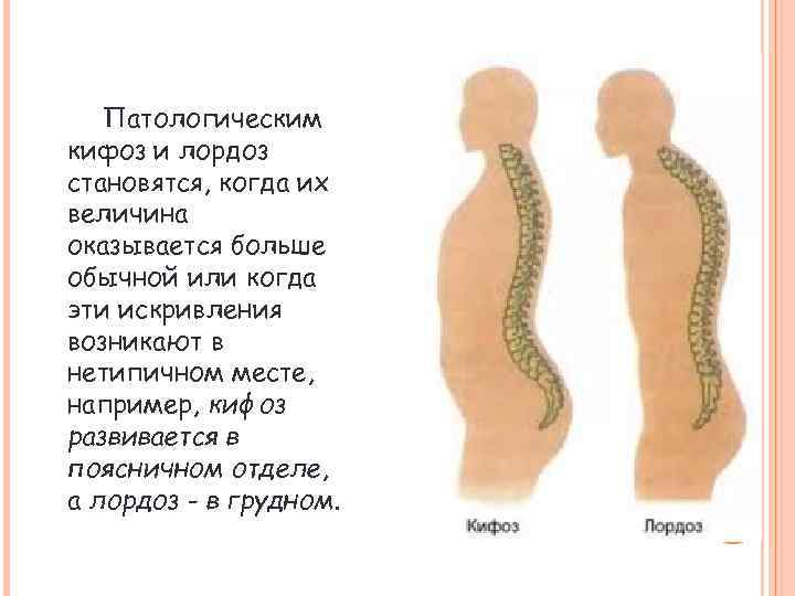 Патологическим кифоз и лордоз становятся, когда их величина оказывается больше обычной или когда эти