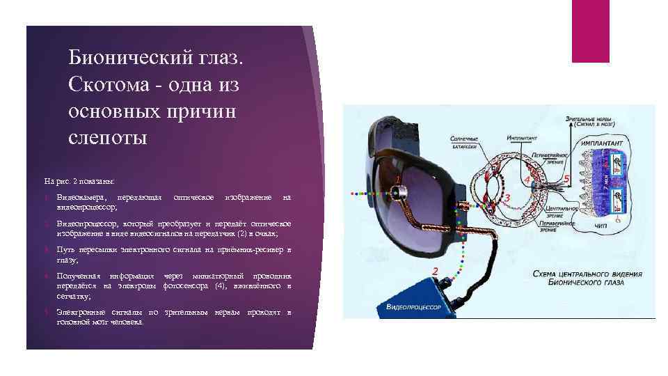 Бионический глаз. Скотома - одна из основных причин слепоты На рис. 2 показаны: 1.