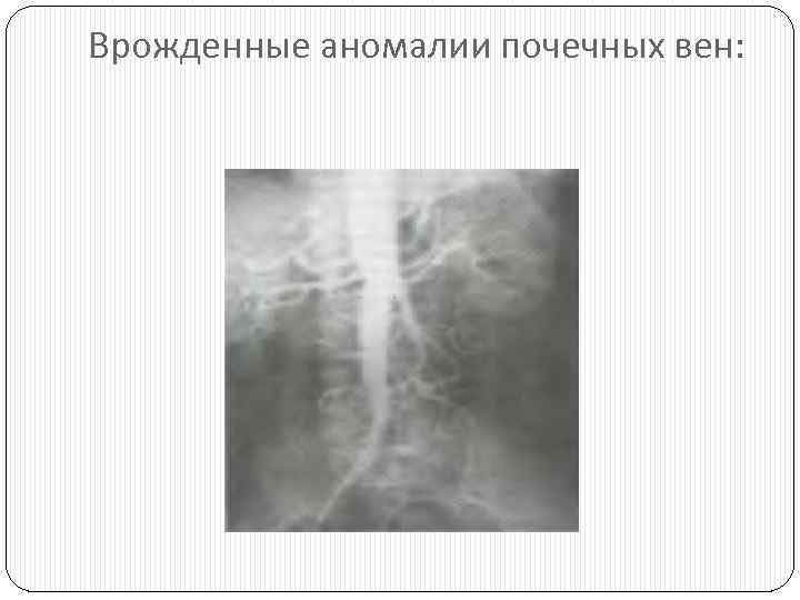 Врожденные аномалии почечных вен: 