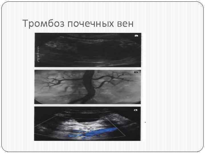 Тромбоз почечных вен 