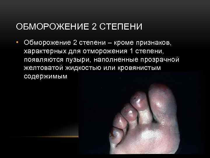 ОБМОРОЖЕНИЕ 2 СТЕПЕНИ • Обморожение 2 степени – кроме признаков, характерных для отморожения 1