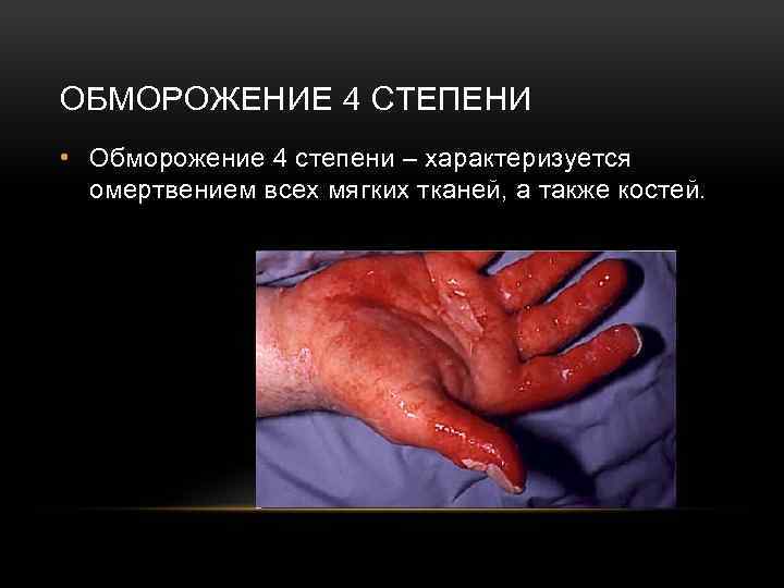 ОБМОРОЖЕНИЕ 4 СТЕПЕНИ • Обморожение 4 степени – характеризуется омертвением всех мягких тканей, а
