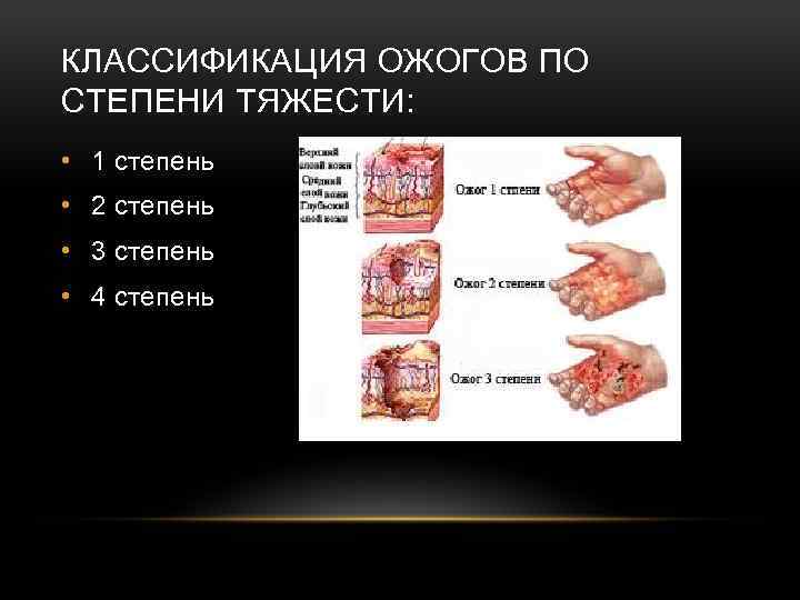 КЛАССИФИКАЦИЯ ОЖОГОВ ПО СТЕПЕНИ ТЯЖЕСТИ: • 1 степень • 2 степень • 3 степень
