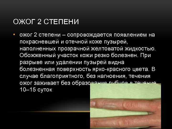 ОЖОГ 2 СТЕПЕНИ • ожог 2 степени – сопровождается появлением на покрасневшей и отечной