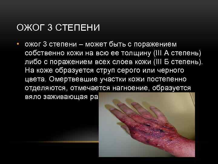 ОЖОГ 3 СТЕПЕНИ • ожог 3 степени – может быть с поражением собственно кожи