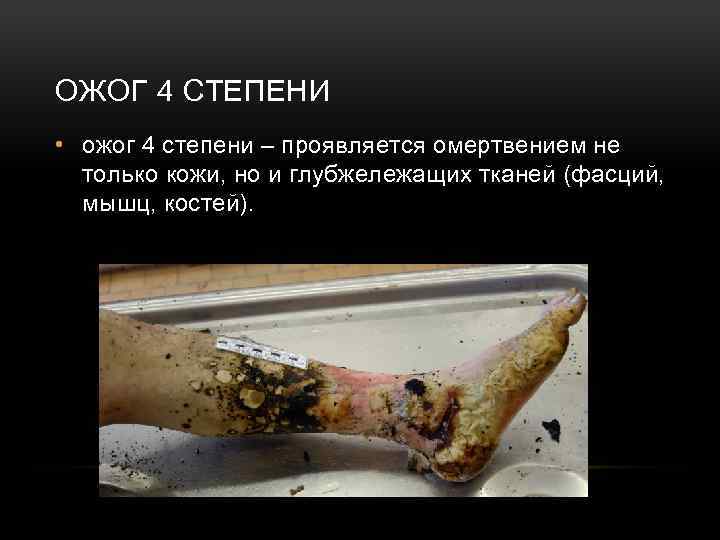 ОЖОГ 4 СТЕПЕНИ • ожог 4 степени – проявляется омертвением не только кожи, но
