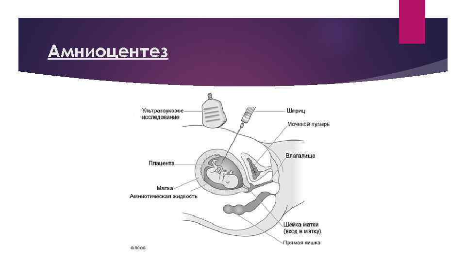 Амниоцентез 