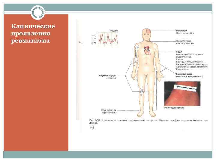 Клинические проявления ревматизма 