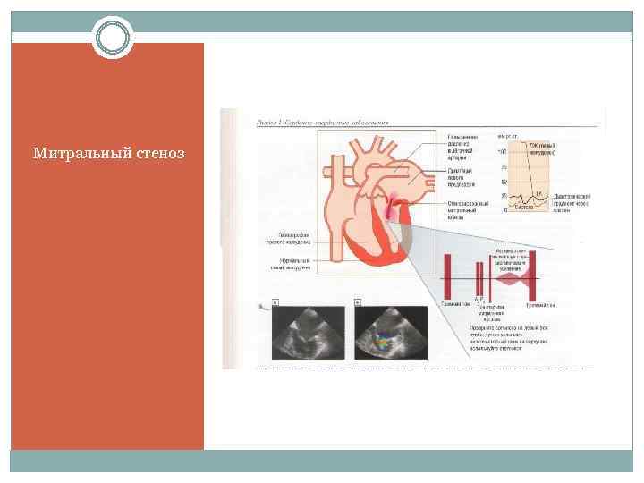 Митральный стеноз 