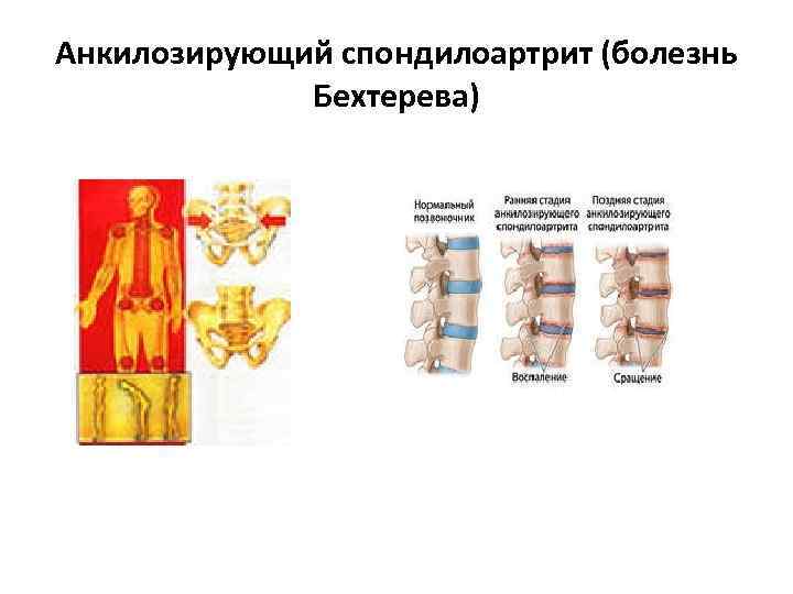 Анкилозирующий спондилоартрит (болезнь Бехтерева) 