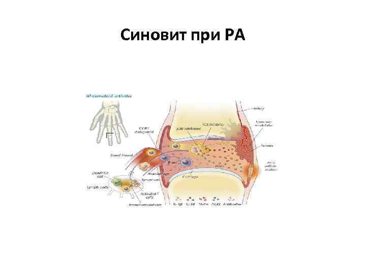 Синовит при РА 