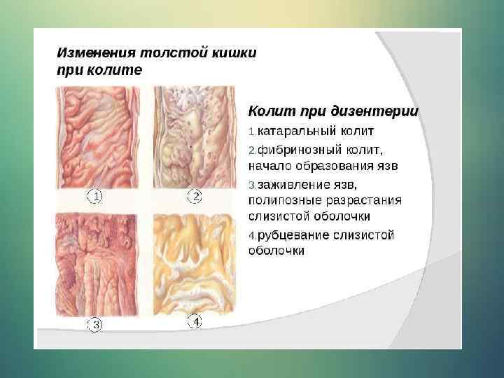 Дизентерия презентация патологическая анатомия