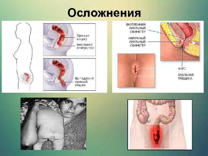 Осложнения 