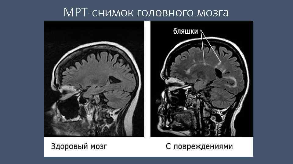 МРТ-снимок головного мозга 