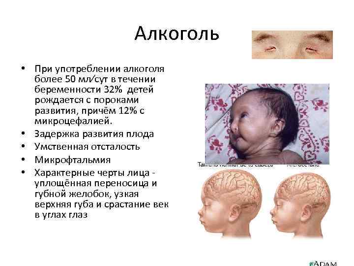 Алкоголь • При употреблении алкоголя более 50 мл∕сут в течении беременности 32% детей рождается