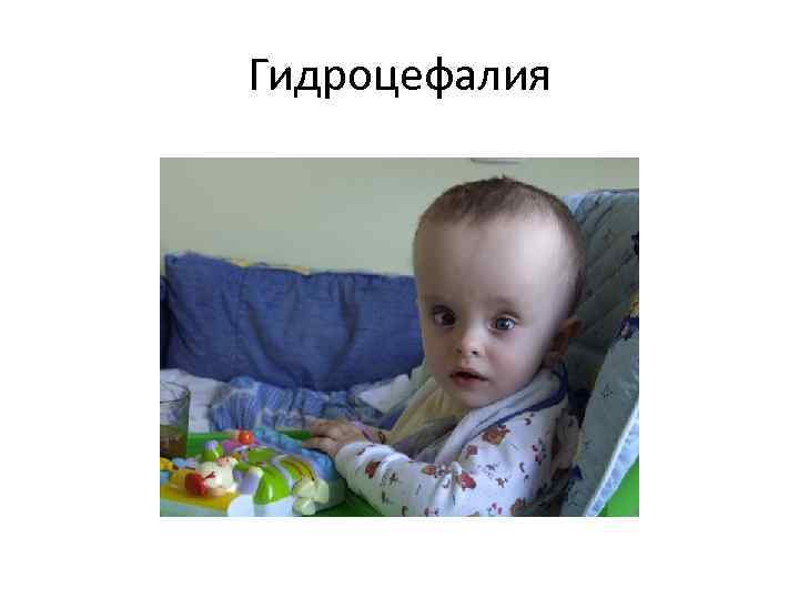 Гидроцефалия 