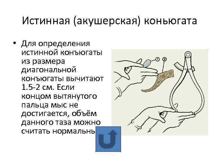 Истинная (акушерская) коньюгата • Для определения истинной конъюгаты из размера диагональной конъюгаты вычитают 1.