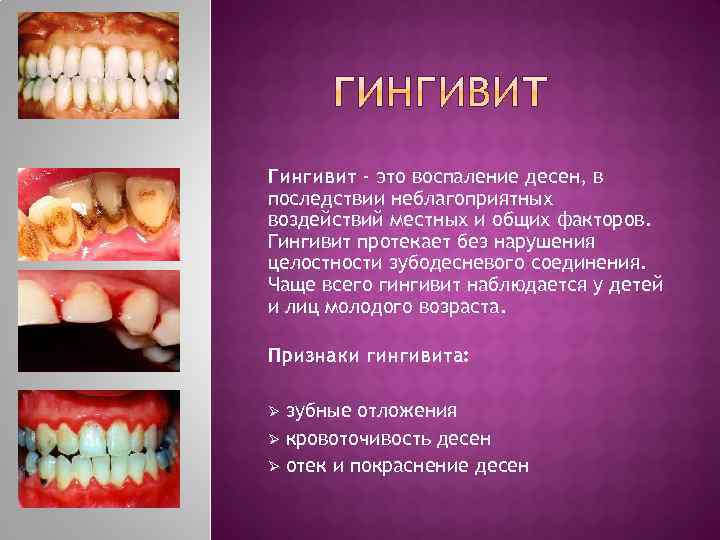 Гингивит - это воспаление десен, в последствии неблагоприятных воздействий местных и общих факторов. Гингивит