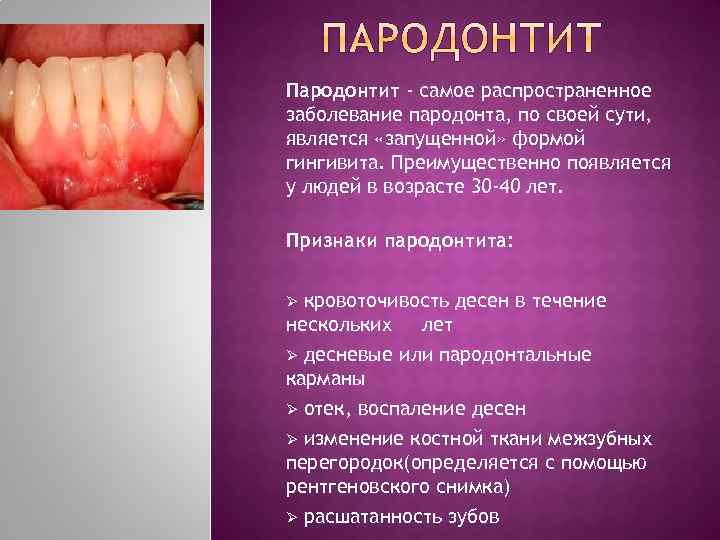 Пародонтит - самое распространенное заболевание пародонта, по своей сути, является «запущенной» формой гингивита. Преимущественно