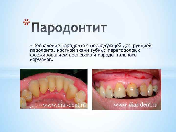 * - Воспаление пародонта с последующей деструкцией пародонта, костной ткани зубных перегородок с формированием