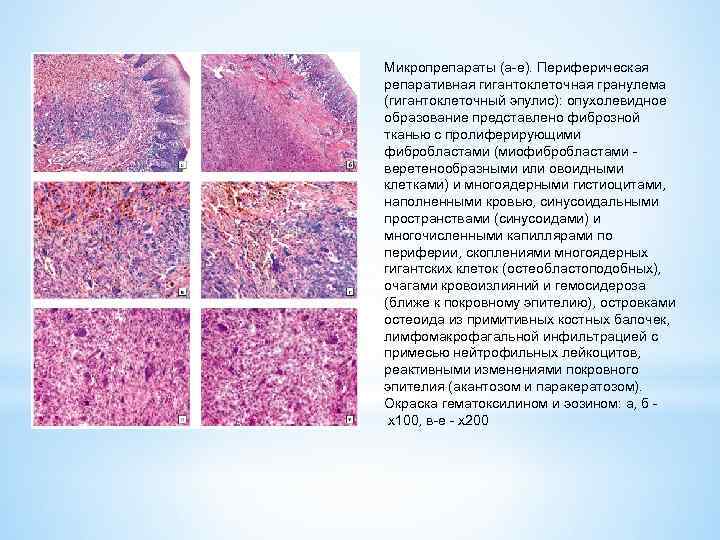 Микропрепараты (а-е). Периферическая репаративная гигантоклеточная гранулема (гигантоклеточный эпулис): опухолевидное образование представлено фиброзной тканью с