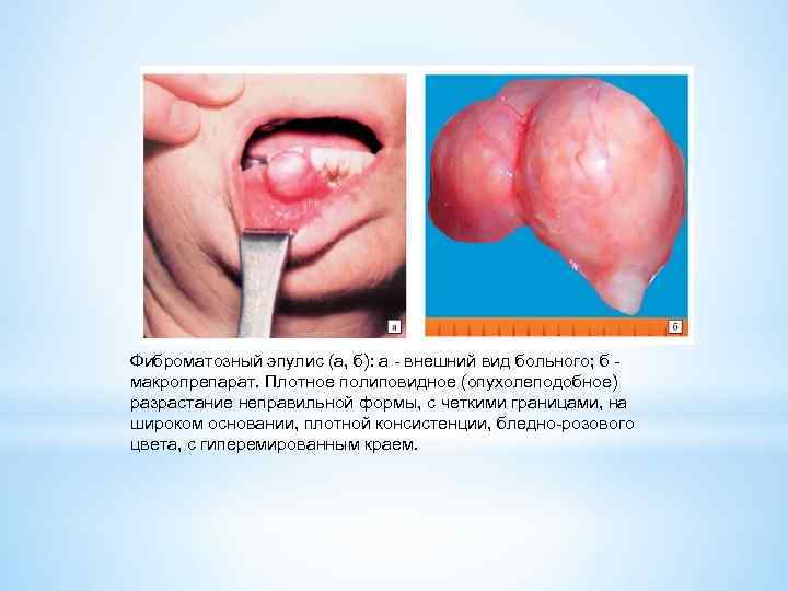 Фиброматозный эпулис (а, б): а - внешний вид больного; б - макропрепарат. Плотное полиповидное